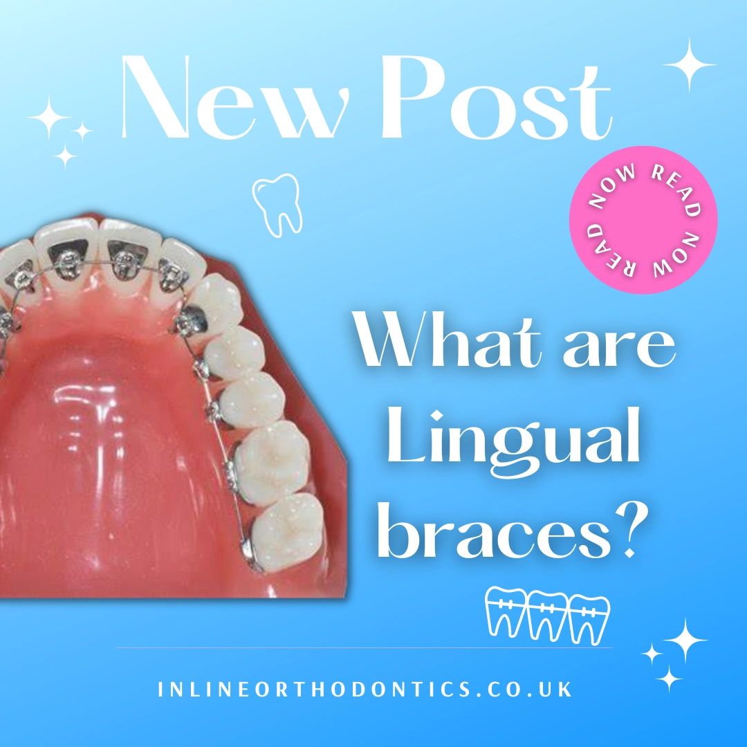 What are Lingual Braces?